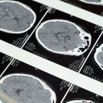 Un vaccino contro l’alzheimer mira a colpire le proteine tau: primi test positivi su animali e primati non umani