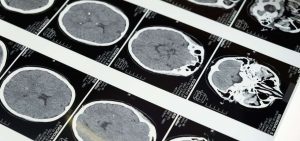 Un_vaccino_contro_l%E2%80%99alzheimer_